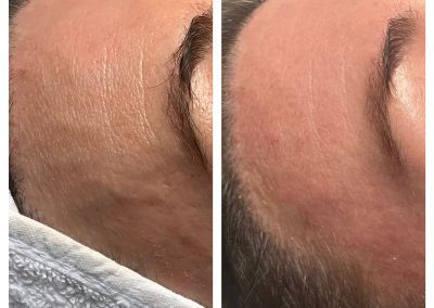 Skin Renewal Peel Results