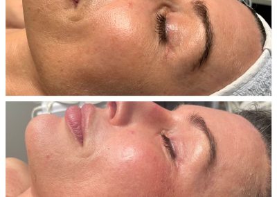 Skin Renewal Peel