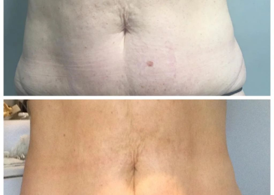 EMSculpt Clinic London Battersea