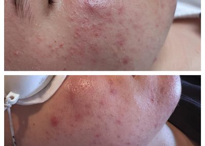 acne treatment YAG laser