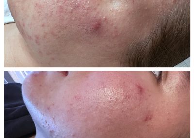 YAG laser for acne